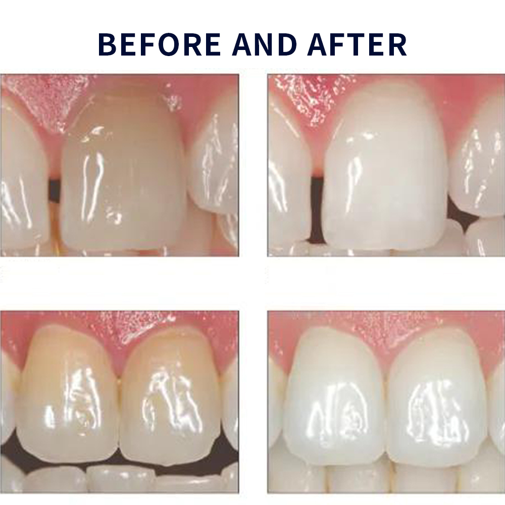 مجموعة جل تبييض أوباليزانس ، م - مراجعة Teeth Whitening Ai وسعره