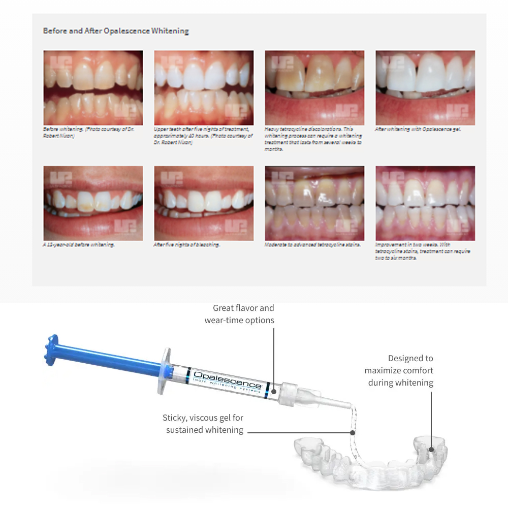 مجموعة جل تبييض أوباليزانس ، م - مراجعة Teeth Whitening Ai وسعره