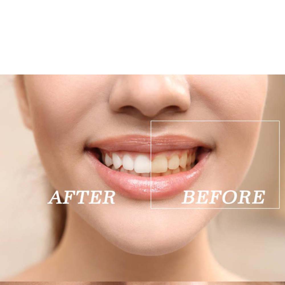 أعلى جودة بيروكسيد الأسنان تبي - مراجعة Teeth Whitening/Bleaching وسعره